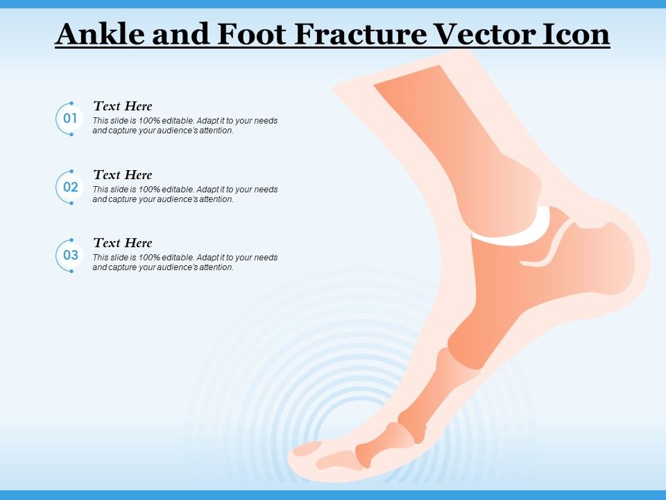 Ankle_And_Foot_Fracture_Vector_Icon_Ppt_PowerPoint_Presentation_Professional_Smartart_PDF_Slide_1.jpg