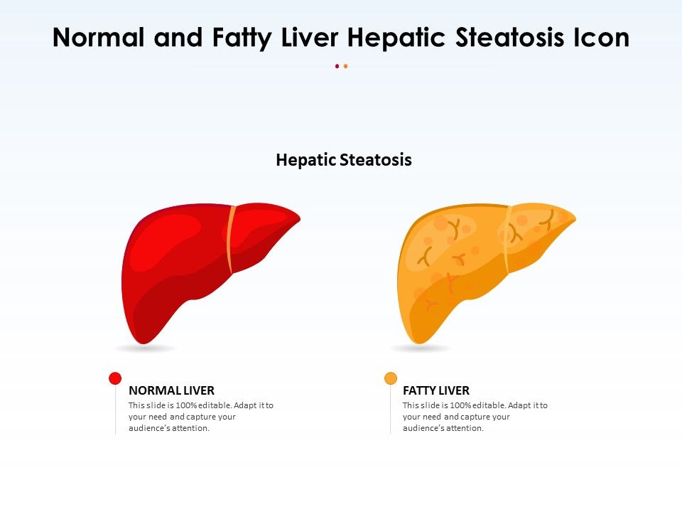 Normal_And_Fatty_Liver_Hepatic_Steatosis_Icon_Ppt_PowerPoint_Presentation_Gallery_Tips_PDF_Slide_1.jpg