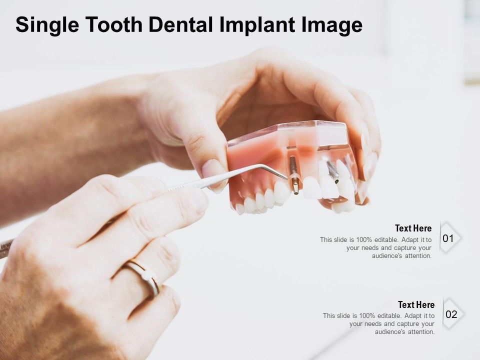 Single_Tooth_Dental_Implant_Image_Ppt_PowerPoint_Presentation_Model_Outfit_PDF_Slide_1.jpg